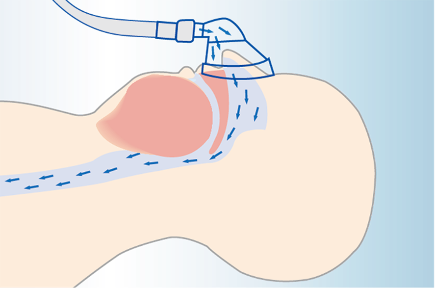CPAP